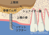 ソケットリフト法説明画像