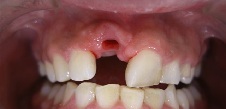 歯を入れる前の写真