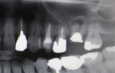 歯を入れる前の写真