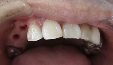 歯が入る前のアップ写真