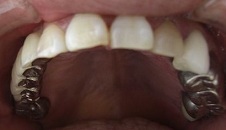 歯が入った後のアップ写真