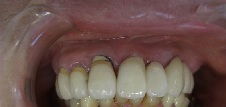 前歯の治療術後写真