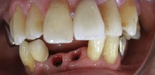 下の前歯の歯科治療前