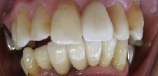 下の前歯の歯科治療後