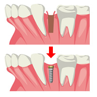 抜歯即時インプラントイメージ