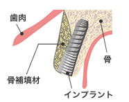 骨増生画像